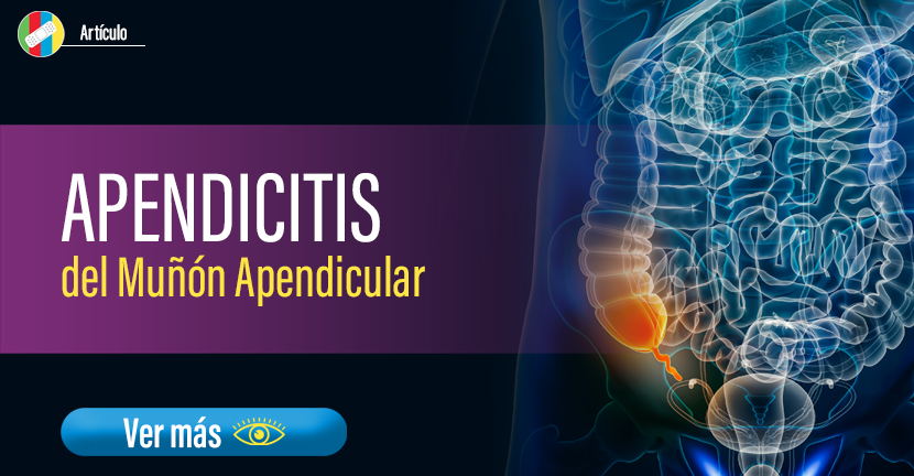 Apendicitis del Muñón Apendicular.